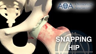 Dislocated Artificial Hip Reduction [upl. by Nido877]