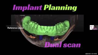 Implant Overdenture Treatment Planning Surgical and Restorative Guidelines [upl. by Nirek90]