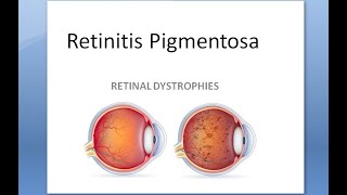 Ophthalmology 297 Retinitis Pigmentosa Dystrophy night blind dominant bone corpuscle ERG vitamin A [upl. by Ligriv]