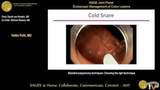 Tratamiento Endoscópico de la Hernia Discal Lumbar Parte 1 [upl. by Anahcra974]