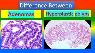 Difference between Adenomas and Hyperplastic Polyps [upl. by Epul845]