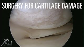 Cartilage Injury Treatment in 2021 [upl. by Teplica]