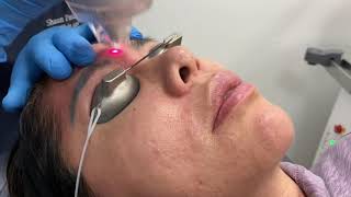 LaseMD Ultra laser treatment for hyperpigmentation and skin rejuvenation in Miami FL by Dr Patel [upl. by Zirtaeb]