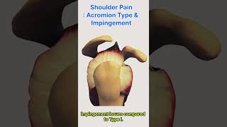 Shoulder Pain  Acromion Type and Impingement Syndrome [upl. by Ashbaugh]