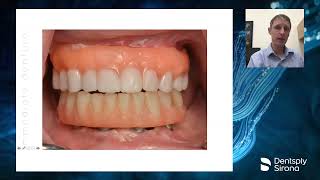 FullArch Digital Implant Restorations with Primescan and Atlantis BridgeBase [upl. by Weinrich]