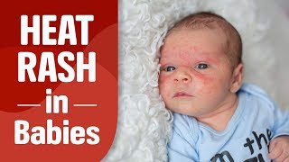 Heat Rash in Babies [upl. by Garretson]