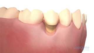 Denture reline  Lapointe dental centres [upl. by Mariann]