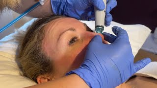 HydraFacial review See the treatment  results up close [upl. by Ronni]