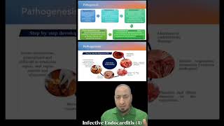 Infective Endocarditis 4 pathogenesis التهاب الشغاف المعدي microbiology medicalstudent [upl. by Naujuj]