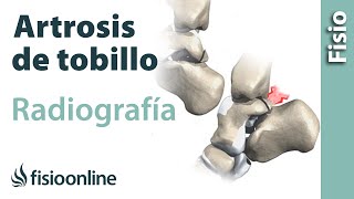 Artrosis de tobillo  Qué es y cómo se diagnostica en radiografías [upl. by Darum]