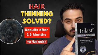 Does Trilast Really Works Is it a perfect hair thinning solution [upl. by Voorhis]