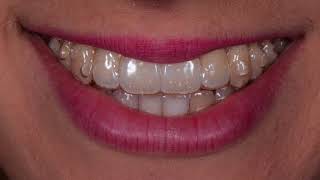 Invisalign Caso Clinico con grave affollamento [upl. by Hallimaj]