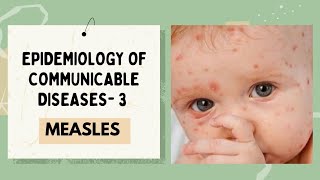 MEASLES EPIDEMIOLOGY OF COMMUNICABLE DISEASE [upl. by Jacobs]