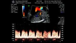 ductus venosus doppler [upl. by Aronid]