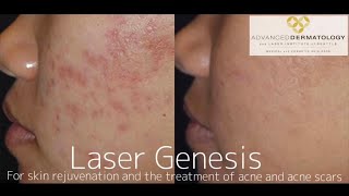 Laser Genesis Treatment at Advanced Dermatology amp Laser Institute of Seattle [upl. by Anuaf]