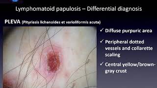 Dermoscopy of Cutaneous lymphomas  Dr Enzo Errichetti [upl. by Bolten763]