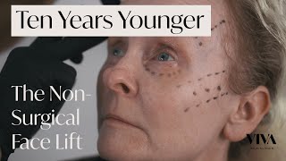 NonSurgical Facelift with Dermal Fillers ❇️ Look 10 Years Younger without Surgery [upl. by Maon]