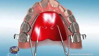 ES Ortho and Distal Jet Appliance [upl. by Gloria]