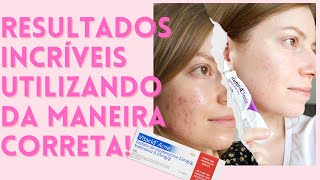 VITACID ACNE Como usar efeitos colaterais funciona Clindamicina  Tretinoína  ACNE E MANCHAS 💦 [upl. by Ecirp]