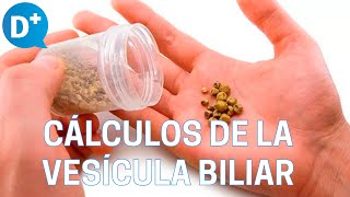 Causas y síntomas de los cálculos de la vesícula biliar [upl. by Aitnuahs]