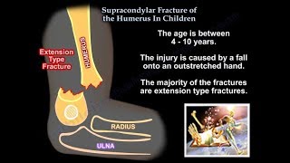 Supracondylar Fracture Of The Humerus In Children  Everything You Need To Know  Dr Nabil Ebraheim [upl. by Keram]