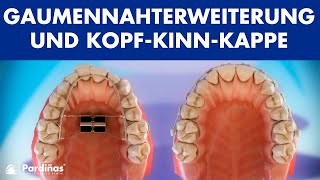 Kieferorthopädie  Gaumennahterweiterung und KopfKinnKappe © [upl. by Saddler267]