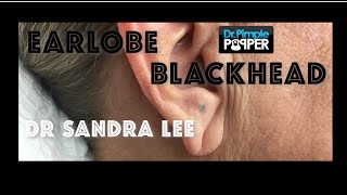 A nice earlobe blackhead extracted [upl. by Gord984]