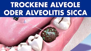 TROCKENE ALVEOLE  Behandlung und Ursachen von ALVEOLITIS sicca © [upl. by Erlinna252]