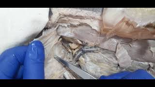 DISSECTION OF INGUINAL CANAL [upl. by Stoneman]