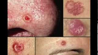 BASAL CELL CARCINOMA Clinical features amp Morphology [upl. by Adnawaj689]