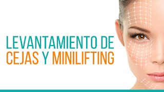 Levantamiento de cejas y Minilifting [upl. by Kimitri]