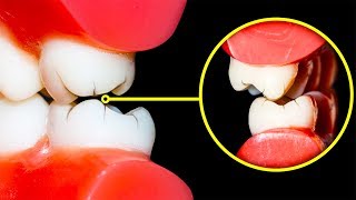 How to Stop Grinding Your Teeth at Night [upl. by Miof Mela]