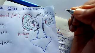 renal carcinoma pathology NGMedicals [upl. by Lsil834]