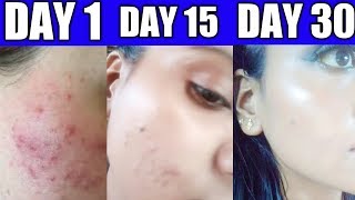 BENZAC AC 25 REVIEW HOW TO PREVENT ACNE  ACNE CREAM  PIMPLE SKINCARE  SHOPOHOLICHEENA [upl. by Heddy945]