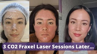 CO2 Fraxel Laser Review 3 Sessions Later  Did My Old Atrophic Acne Scars Improve  michxmash [upl. by Eyaf]