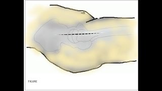 Hardinge Approach  Lateral Approach to the Hip [upl. by Koah866]