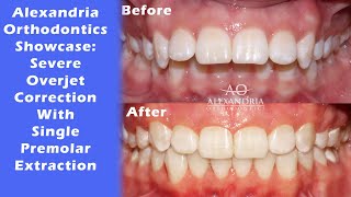 Alexandria Orthodontics Showcase ⁠Severe Overjet correction with single premolar extraction⁠ [upl. by Nojed943]