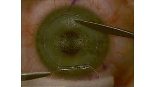 LASIK flap handling technique [upl. by Seabrook]