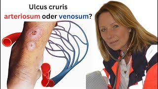 Was ist der Unterschied zwischen einem ulcus cruris arteriosum und venosum [upl. by Ahsieyn104]