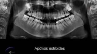 Anatomía en la radiografía panorámica II Anatomic panoramic image II [upl. by Dahsra]