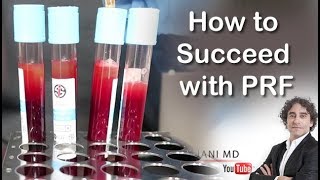 HOW TO EXCEED WITH PRF FACE INJECTIONSDr Rajani [upl. by Aineval212]