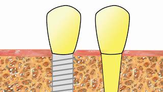 Die Entzündung am Implantat Ursache und Behandlung [upl. by Salim]