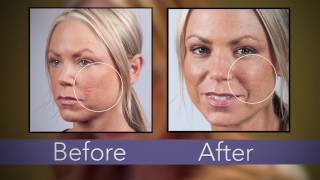 Dermaflage The Solution for Hiding Acne Scars Chicken Pox Scars Box Car Scars [upl. by Nydnarb]