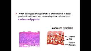 Leukoplakia EtiopathogenesisPPTpremalignant lesion [upl. by Ttennej]