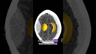 subdural vs epidural 🧠🤔 Interesante caso de hematoma subagudo por tomografia radiology [upl. by Ahsat]