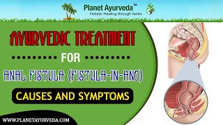 Ayurvedic Treatment for Fistula in Ano  Causes and Symptoms [upl. by Anala71]