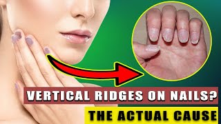 The REAL Causes of VERTICAL RIDGES On Your Nails [upl. by Ezzo]