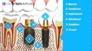 MegaGen Implant  Patient informatie [upl. by Okkin921]