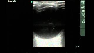 Ocular Ultrasound Vitreous Hemorrhage [upl. by Mcwilliams]