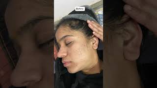 Tretinoin before and after look tretinoin cream darkspots acne glow darkspots face pimple [upl. by Eelan]